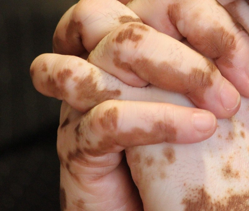Leucoderma or Vitiligo on hands